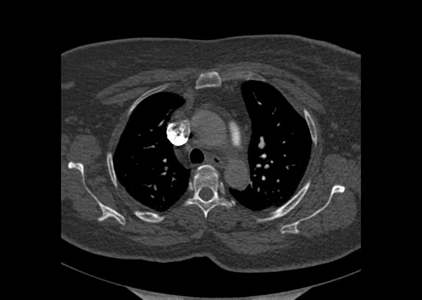 Acute pulmonary embolism (Radiopaedia 29938-30466 Axial C+ CTPA 7).jpg