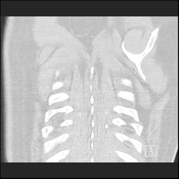 File:Acute pulmonary embolism with pulmonary infarct (Radiopaedia 73062-83768 Coronal lung window 72).jpg