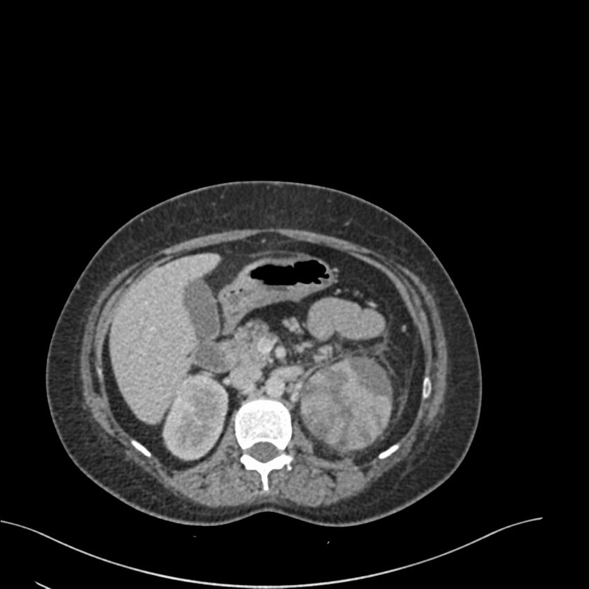 Acute pyelonephritis with renal vein thrombosis (Radiopaedia 58020-65053 Axial renal parenchymal phase 41).jpg