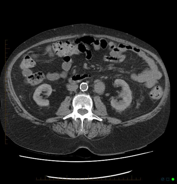 File:Acute renal failure post IV contrast injection- CT findings (Radiopaedia 47815-52557 Axial non-contrast 40).jpg