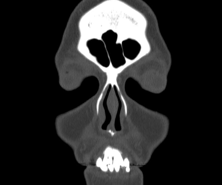 File:Acute sinusitis (Radiopaedia 22419-22455 Coronal bone window 3).jpg