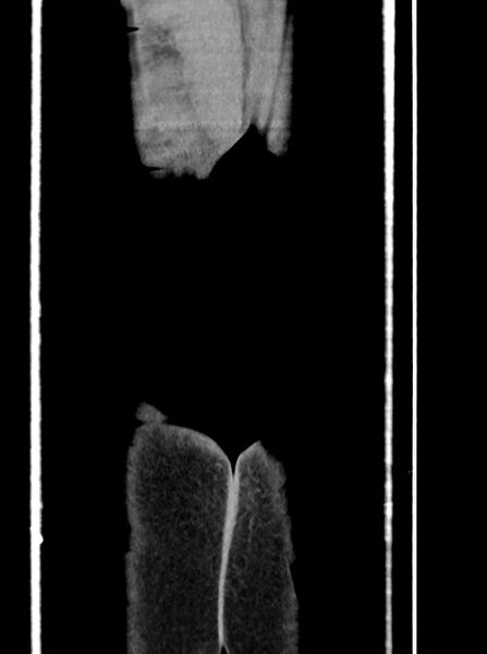 File:Acute small bowel (ileal) volvulus (Radiopaedia 71740-82139 Coronal C+ portal venous phase 114).jpg