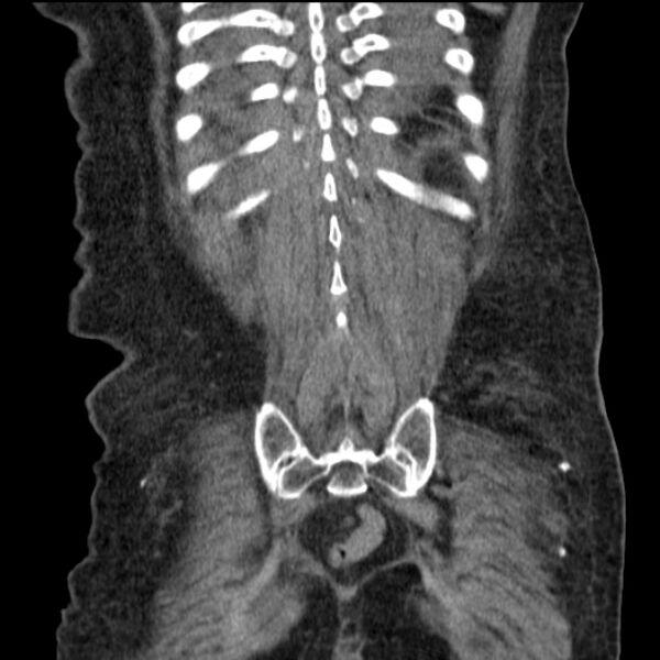 File:Acute tubular necrosis (Radiopaedia 28077-28334 G 71).jpg