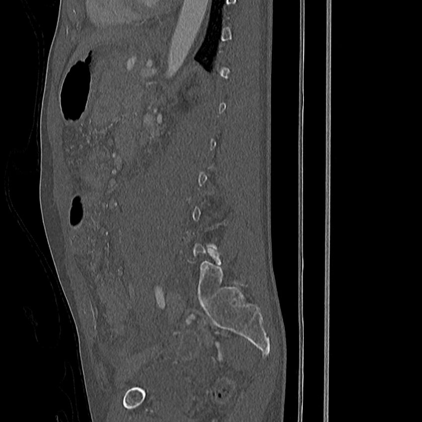 Acute vertebral body compression fractures (Radiopaedia 31757-32693 Sagittal bone window 11).jpg