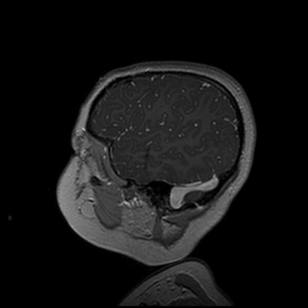 File:Adamantinomatous craniopharyngioma (Radiopaedia 77407-89529 H 20).jpg