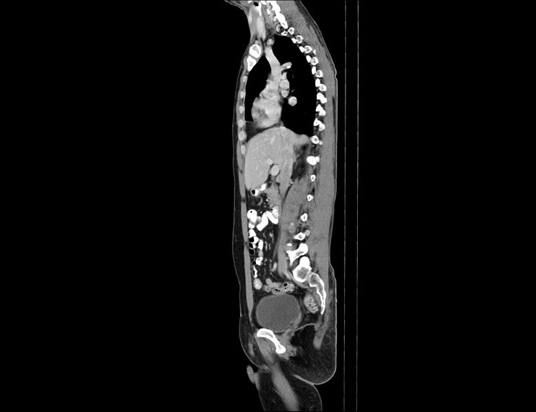 File:Addison disease (Radiopaedia 49318-54412 Sagittal C+ portal venous phase 41).jpg