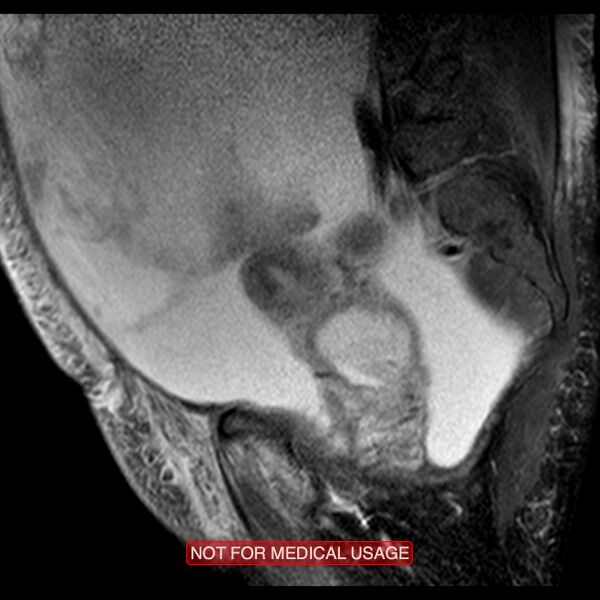 File:Adenocarcinoma of the cervix (Radiopaedia 28373-28615 Sagittal T2 fat sat 13).jpg