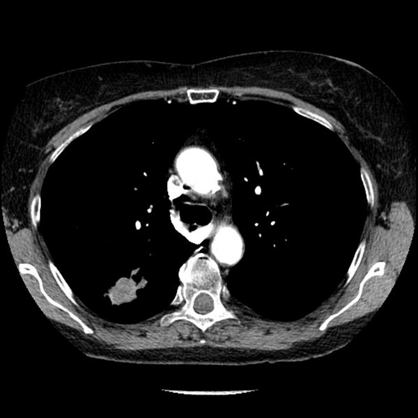 File:Adenocarcinoma of the lung (Radiopaedia 41015-43755 Axial C+ portal venous phase 41).jpg