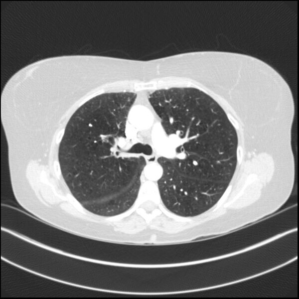 File:Adenocarcinoma of the lung (Radiopaedia 44205-47803 Axial lung window 38).jpg