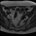 Adenoma malignum of the cervix (Radiopaedia 24460-24765 C 1).jpg