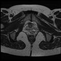 Adenoma malignum of the cervix (Radiopaedia 24460-24765 C 25).jpg