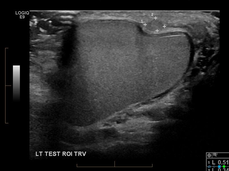 File:Adenomatoid tumor of the testicular tunica (Radiopaedia 30695-31388 Transverse 1).jpg