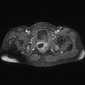 Adenomyoma of the uterus (huge) (Radiopaedia 9870-10438 Axial T1 C+ fat sat 8).jpg