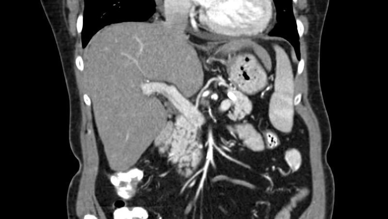 File:Adenomyomatosis of the gallbladder (Radiopaedia 12142-12483 Coronal C+ arterial phase 19).jpg