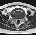 Adenomyosis - ovarian endometriomas (Radiopaedia 67031-76350 Axial T2 12).jpg