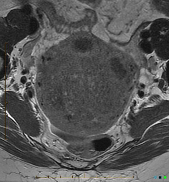 File:Adenomyosis uterus with hematometra (Radiopaedia 45779-50011 Axial T2 11).jpg