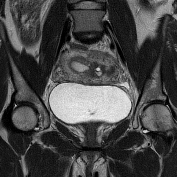File:Adenomyosis within a septate uterus (Radiopaedia 69963-79981 Coronal T2 13).jpg