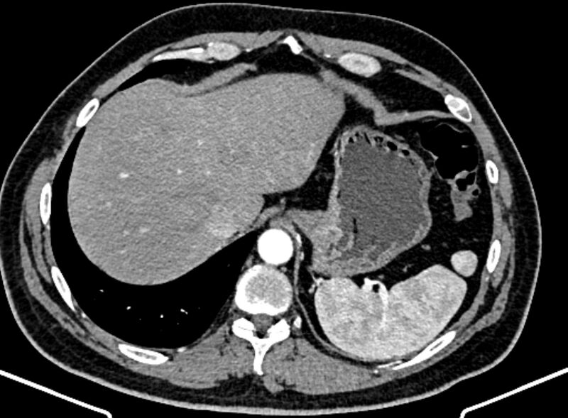 File:Adrenal metastases (Radiopaedia 73082-83791 Axial C+ arterial phase 25).jpg