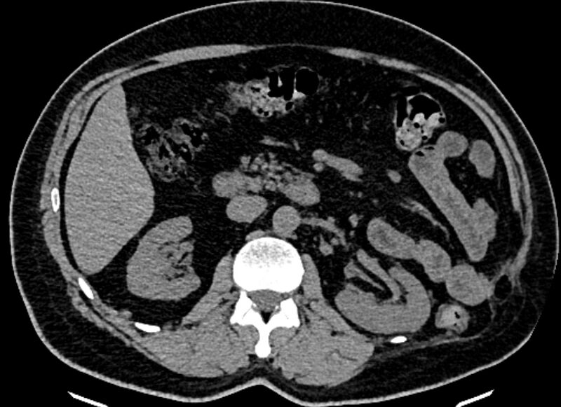 File:Adrenal metastases (Radiopaedia 73082-83791 Axial non-contrast 77).jpg