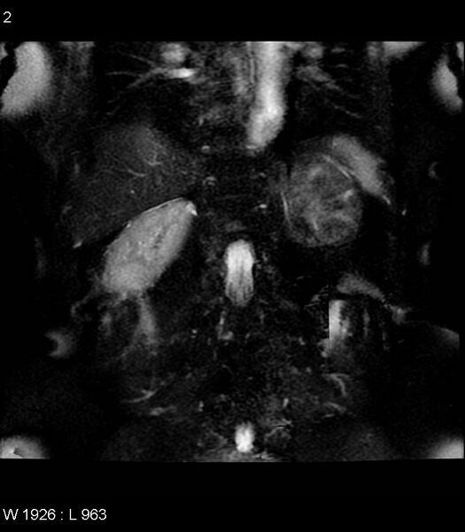 File:Adrenal myelolipoma (Radiopaedia 6765-7961 Coronal T2 fat sat 2).jpg