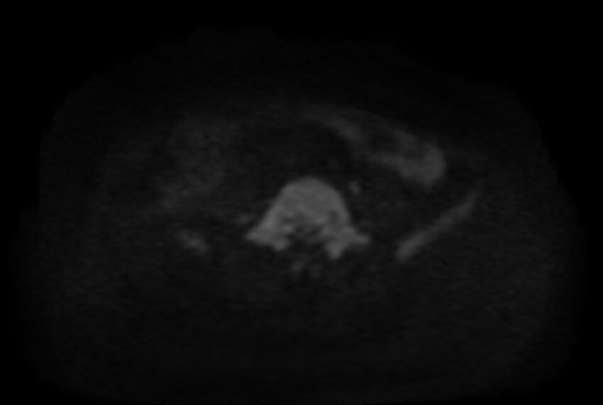Adult ileal intussusception with secondary obstruction (Radiopaedia 30395-31051 Coronal C+ portal venous phase 14).jpg
