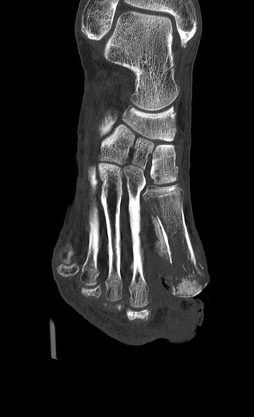 File:Advanced osteomyelitis due to open metatarsal fracture (Radiopaedia 83891-99095 Coronal bone window 9).jpg