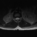Aggressive vertebral hemangioma (Radiopaedia 39937-42404 Axial T2 3).png