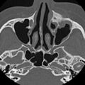 Ameloblastic fibro-odontoma (Radiopaedia 18843-18780 C 12).jpg