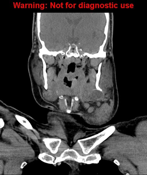 File:Ameloblastoma (Radiopaedia 33126-34164 D 38).jpg