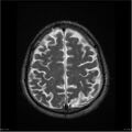 Amnestic syndrome secondary to hypoxic brain injury (Radiopaedia 24743-25004 T2 17).jpg