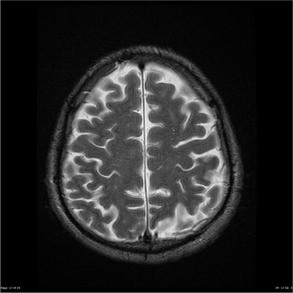 File:Amnestic syndrome secondary to hypoxic brain injury (Radiopaedia 24743-25004 T2 17).jpg