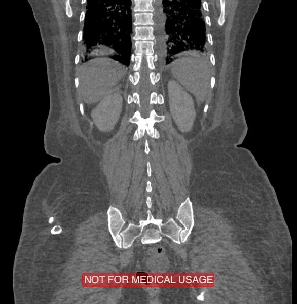File:Amoebic enterocolitis with liver abscess (Radiopaedia 35100-36609 B 170).jpg