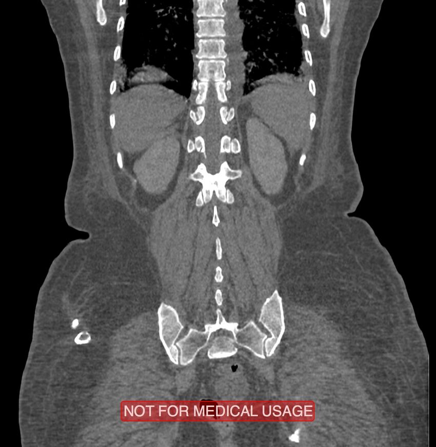 Amoebic enterocolitis with liver abscess (Radiopaedia 35100-36609 B 170).jpg