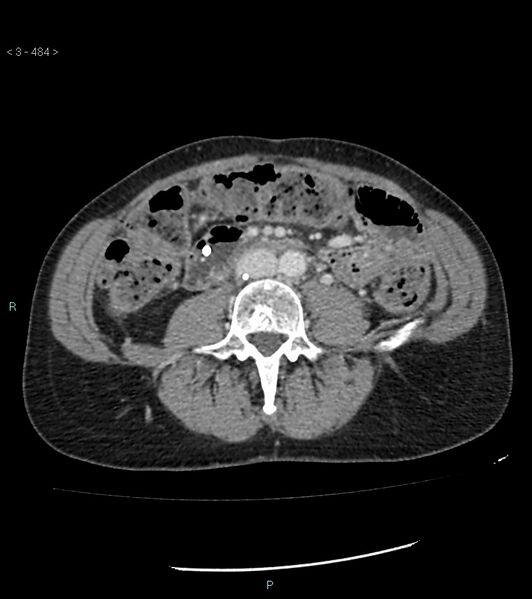 File:Ampulla of Vater metastasis (Radiopaedia 27820-28069 A 122).jpg