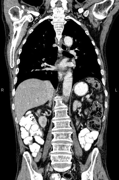 File:Ampullary adenocarcinoma (Radiopaedia 86093-102033 D 37).jpg