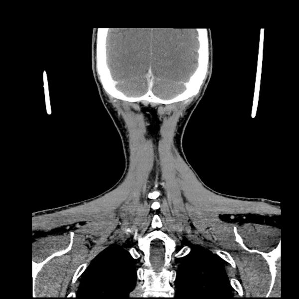 File:Anaplastic thyroid carcinoma (Radiopaedia 79087-92034 A 100).jpg