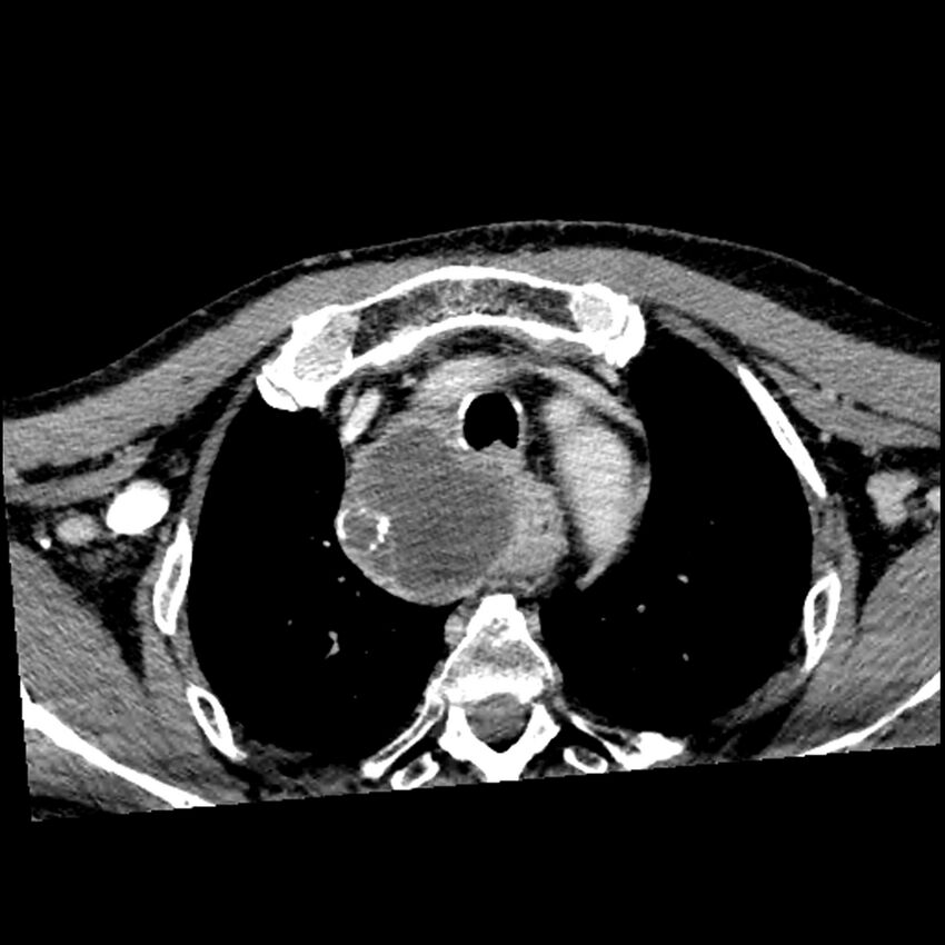 Anaplastic thyroid carcinoma (Radiopaedia 79087-92034 B 15).jpg