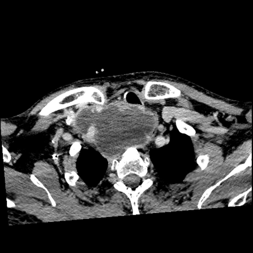 Anaplastic thyroid carcinoma (Radiopaedia 79087-92034 B 30).jpg