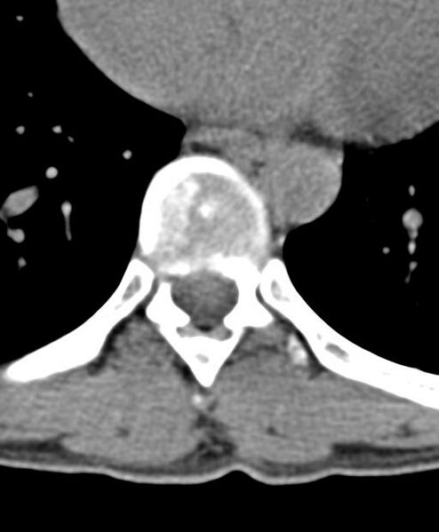 File:Aneurysmal bone cyst T11 (Radiopaedia 29294-29721 Axial non-contrast 19).jpg