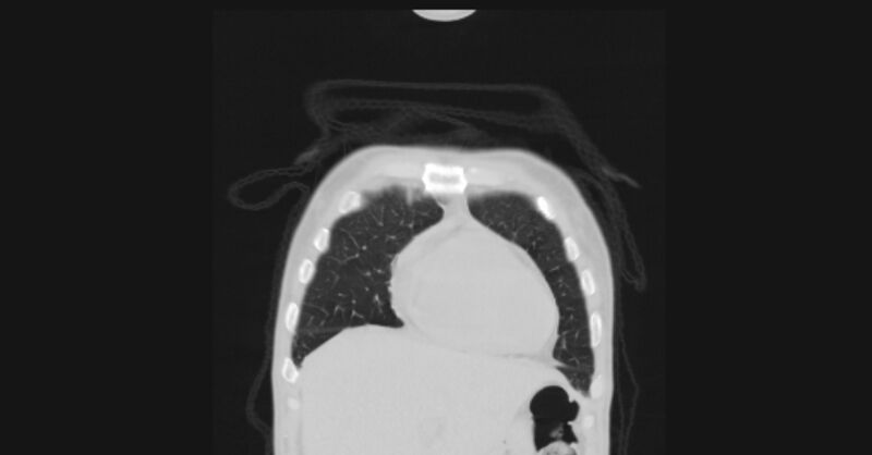 File:Angioinvasive aspergellosis (Radiopaedia 66995-76315 Coronal lung window 8).jpg