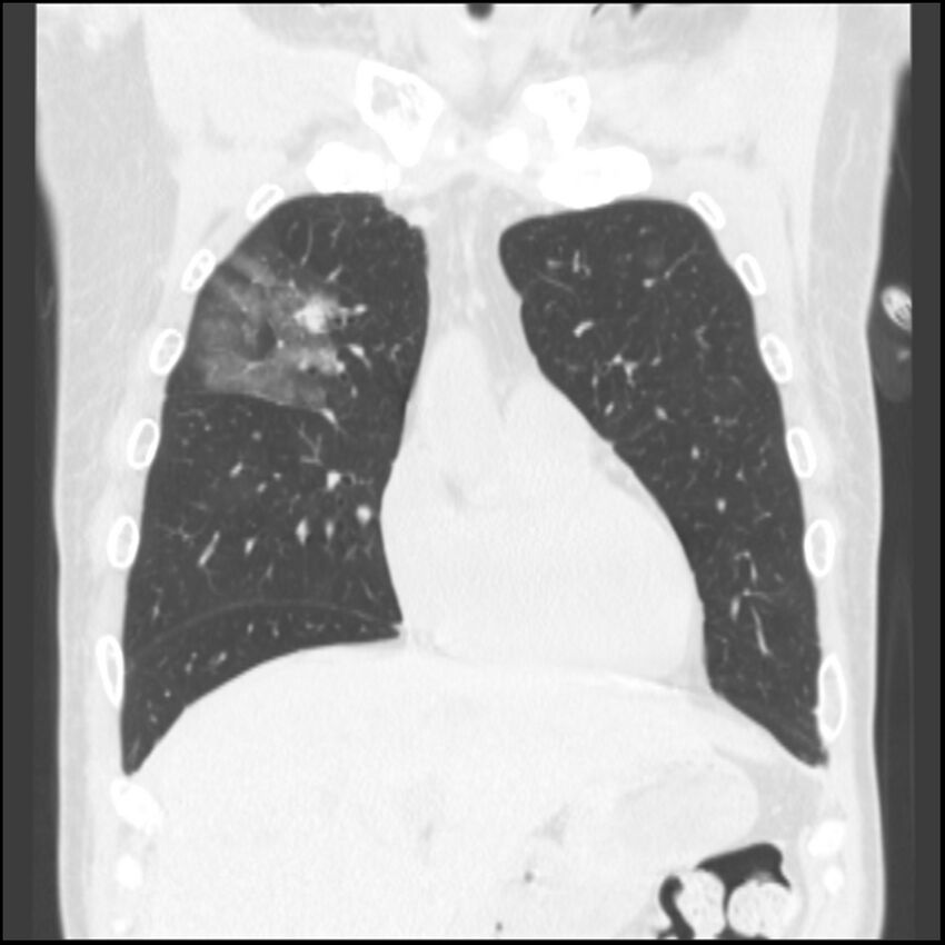 Angioinvasive aspergillosis (Radiopaedia 43957-47466 Coronal lung window 67).jpg