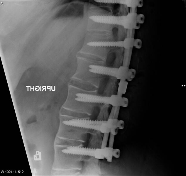 File:Ankylosing spondylitis - chalk stick fracture (Radiopaedia 4832-6791 A 1).jpg