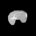 Annular pancreas (Radiopaedia 38292-40322 Sagittal 5).png