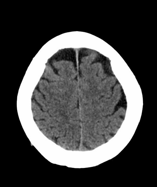 File:Anomalous intracranial venous drainage (Radiopaedia 28161-28418 Axial 46).png
