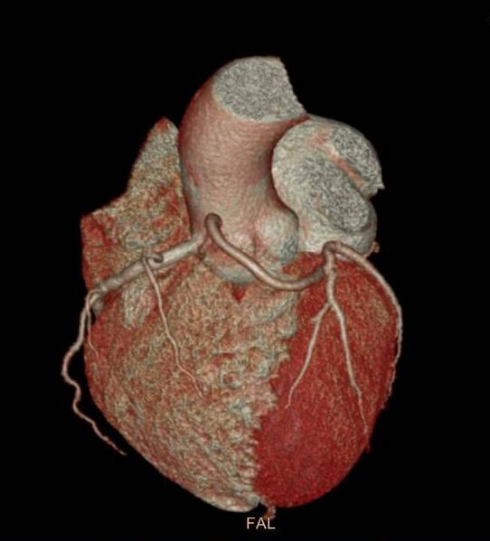 File:Anomalous left coronary artery- prepulmonic course (Radiopaedia 29253-29667 3D VRT 1).JPG