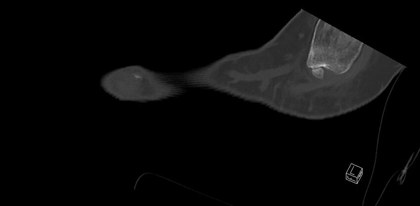 Anterior calcaneal process fracture (Radiopaedia 63353-71943 C 52).jpg