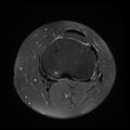 Anterior cruciate ligament tear, Wrisberg rip and bucket-handle tear of medial meniscus (Radiopaedia 75872-87266 Axial PD fat sat 7).jpg