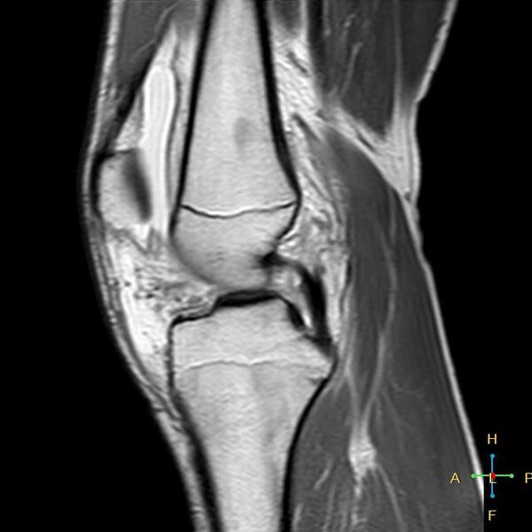 File:Anterior cruciate ligament tear - complete (Radiopaedia 24907-25170 Sagittal PD 10).jpg