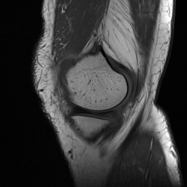 File:Anterior cruciate ligament tear - ramp lesion (Radiopaedia 71883-82322 Sagittal T1 21).jpg