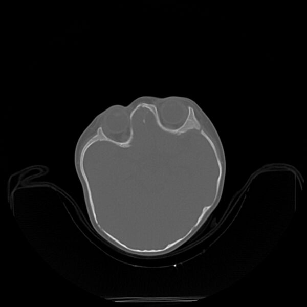 File:Anterior plagiocephaly (Radiopaedia 71836-82273 C 17).jpg